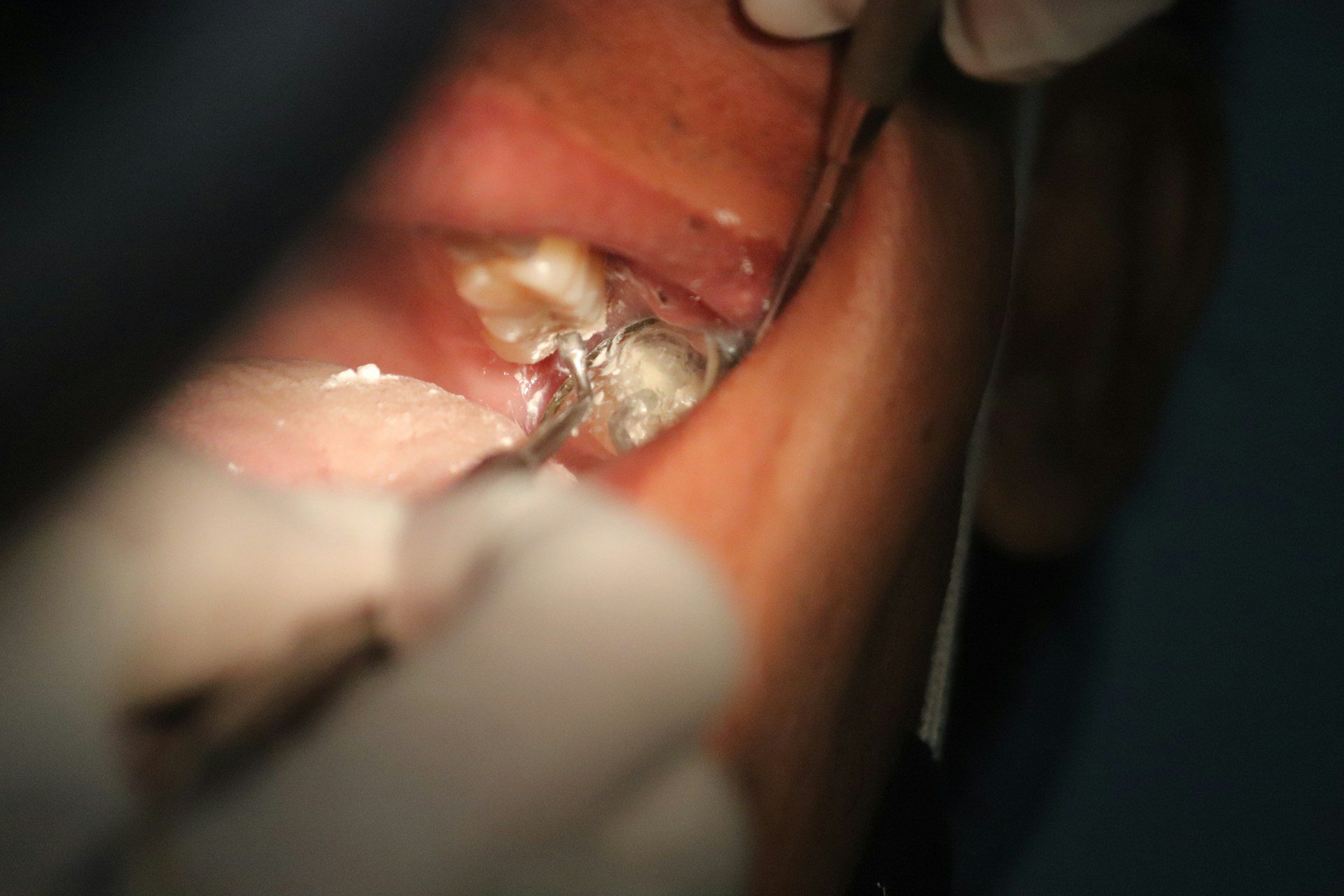The Science Behind a Stronger Smile: Understanding Implant Technology